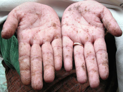 mercury-poisoning